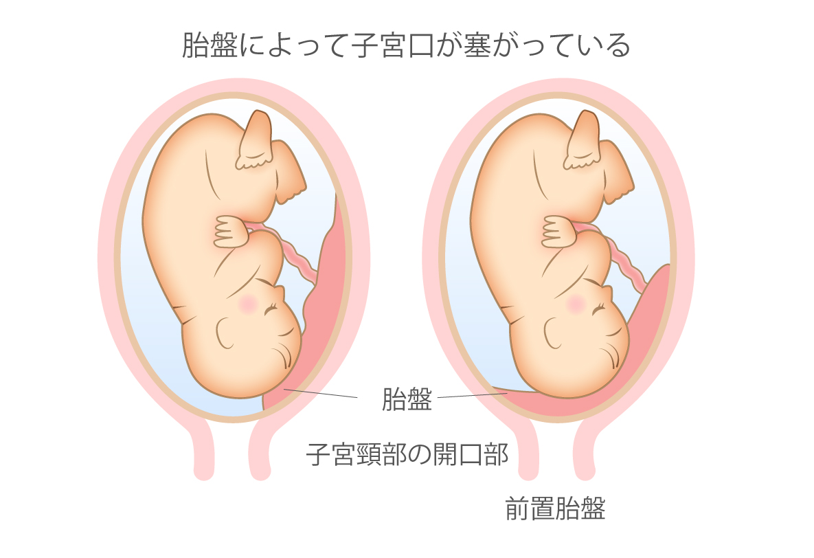 前置胎盤