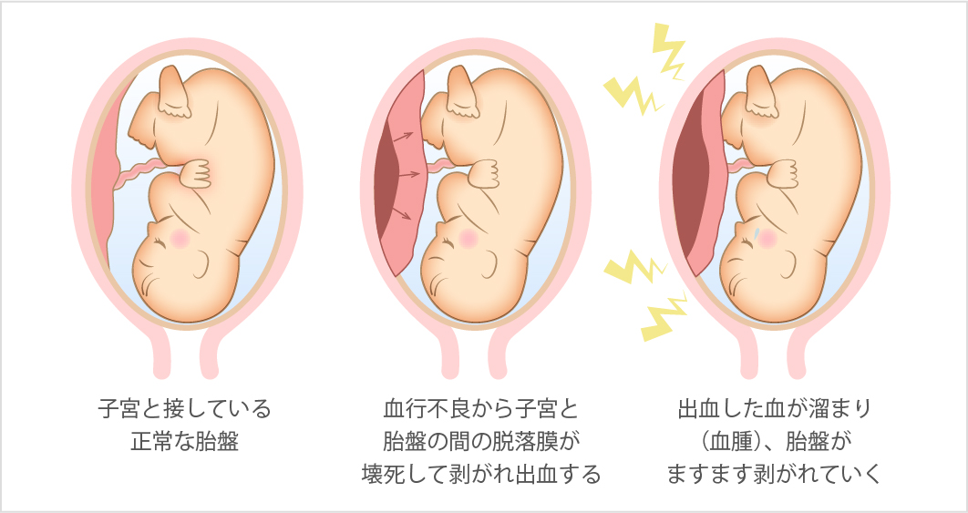 無事に生まれる率が下がる