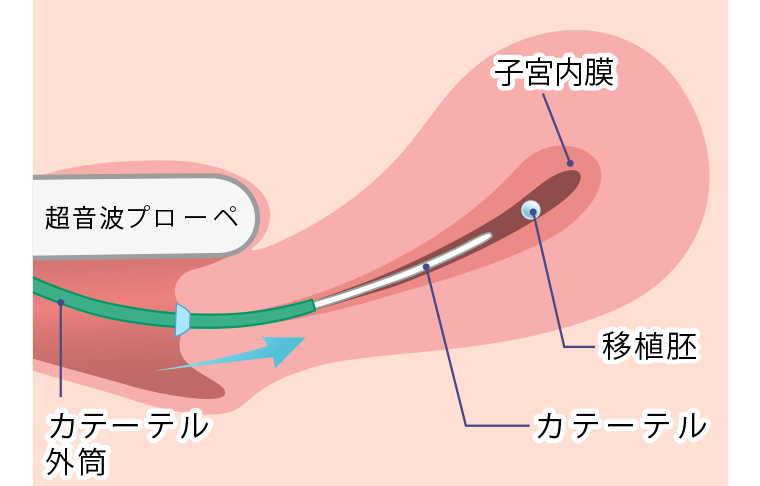 胚移植